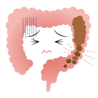 けいれん性便秘の腸