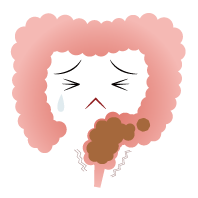 直腸性便秘の腸