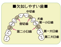 欠如しやすい歯は