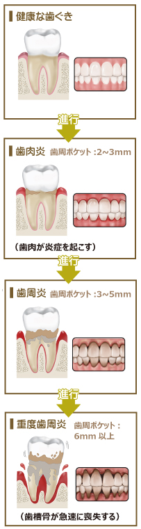 歯周病の進行