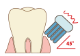 歯周病予防のブラッシング法