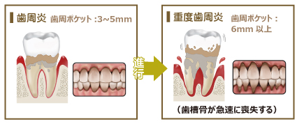 健康な歯から歯肉炎へ移行