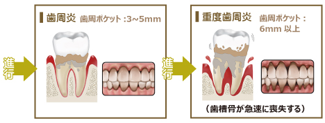 歯周病の進行