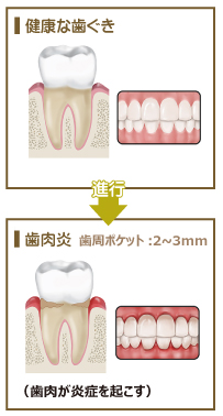 歯周病の進行