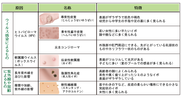 イボの種類表