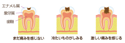 虫歯の進行