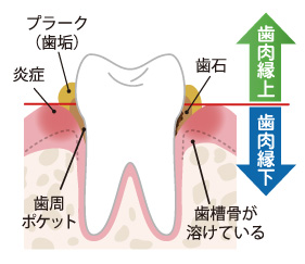 歯肉縁上と歯肉縁下のプラークと歯石