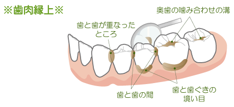 プラークがつきやすい場所