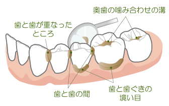 プラークがつきやすい場所