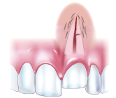 埋入して歯根破折