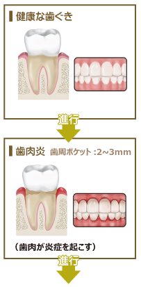健康な歯から歯肉炎へ移行