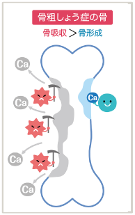 骨粗しょう症の骨は骨形成より骨吸収が上回る
