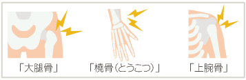 骨折しやすい部位ベスト3