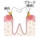 歯垢(プラーク)